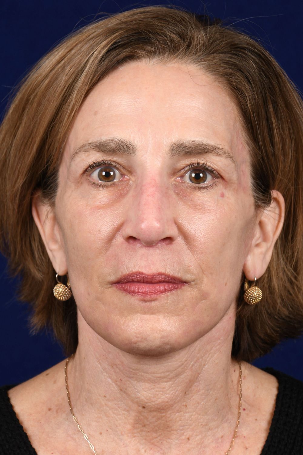 Facial Rejuvenation Before & After