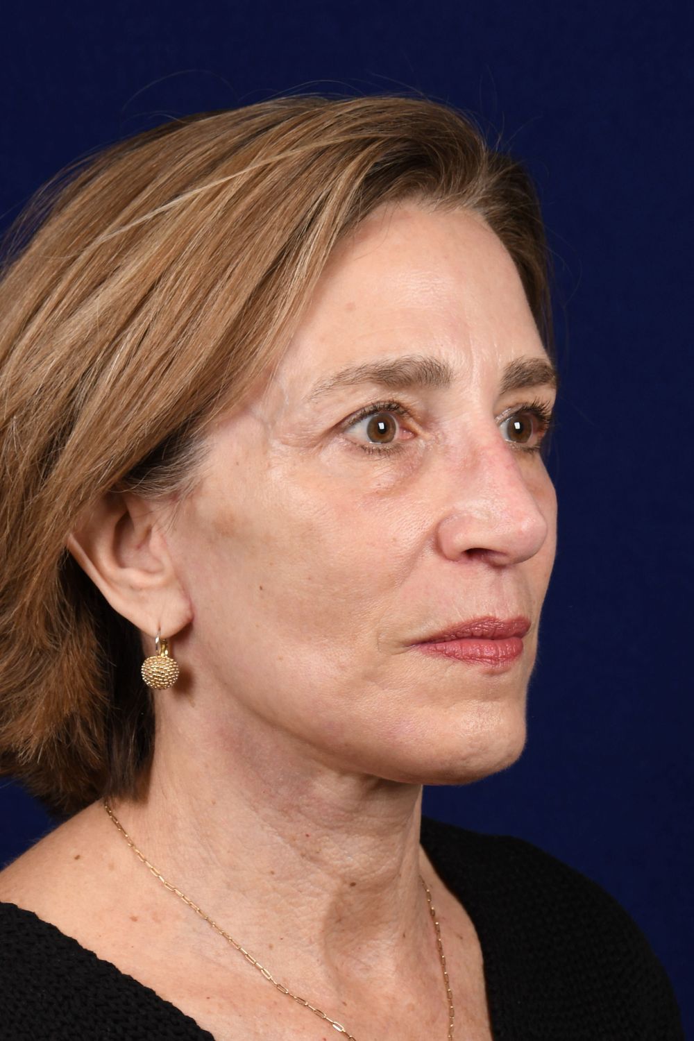 Facial Rejuvenation Before & After