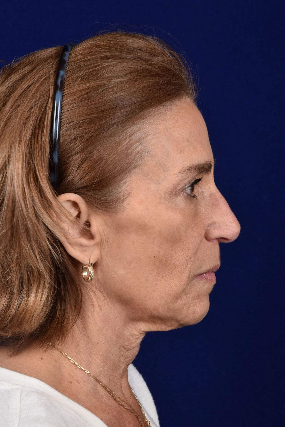 Facial Rejuvenation Before & After