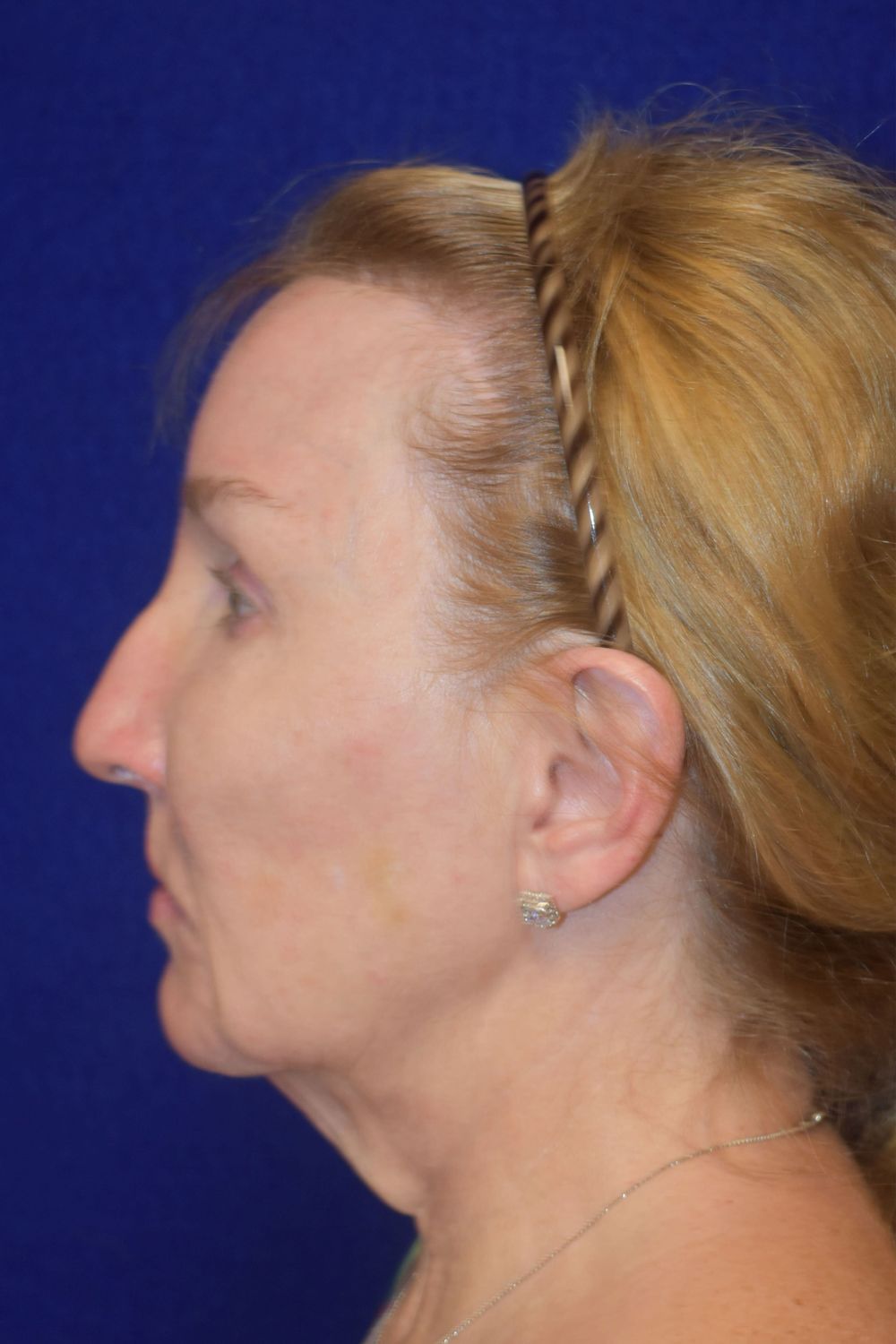 Facial Rejuvenation Before & After