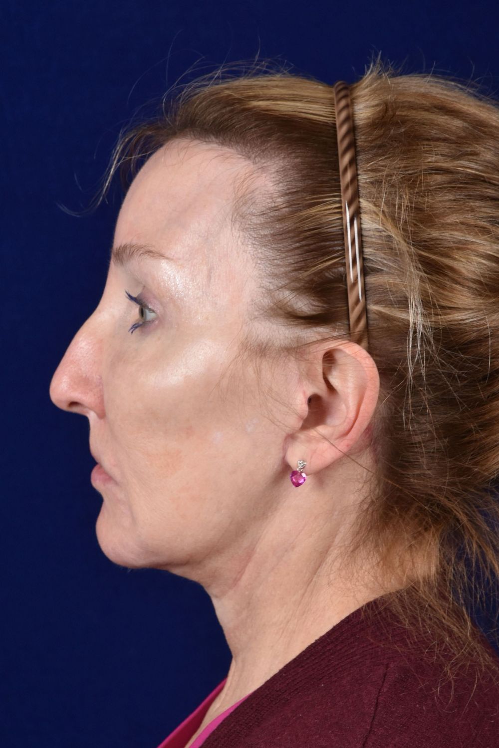 Facial Rejuvenation Before & After