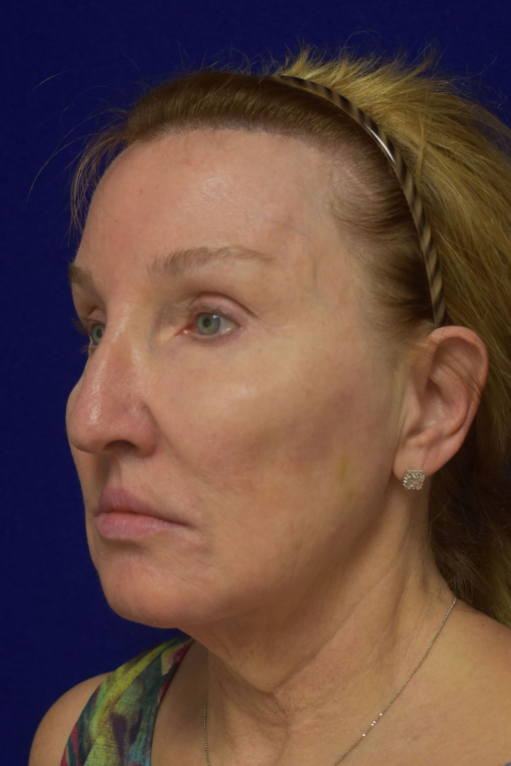Facial Rejuvenation Before & After