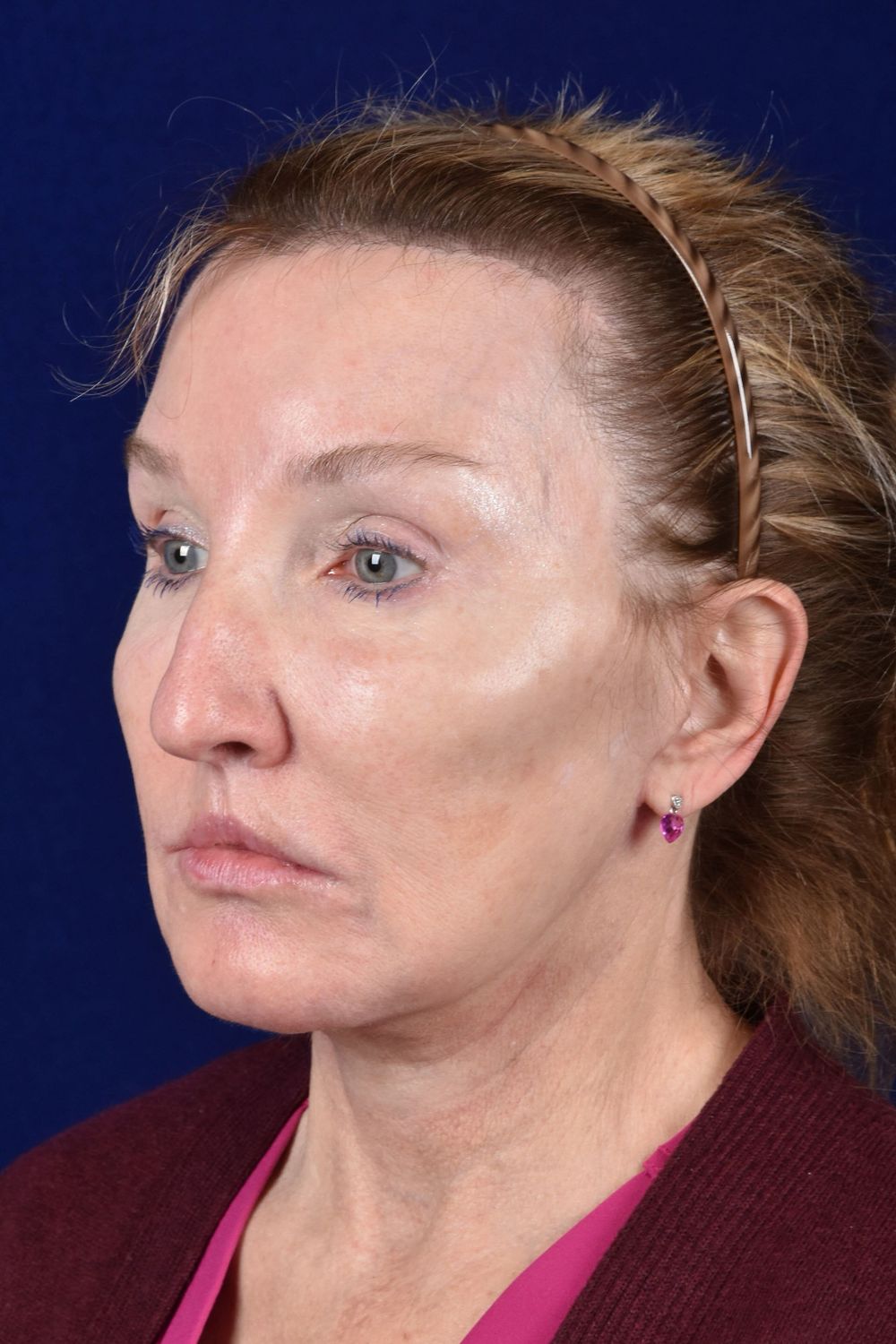 Facial Rejuvenation Before & After