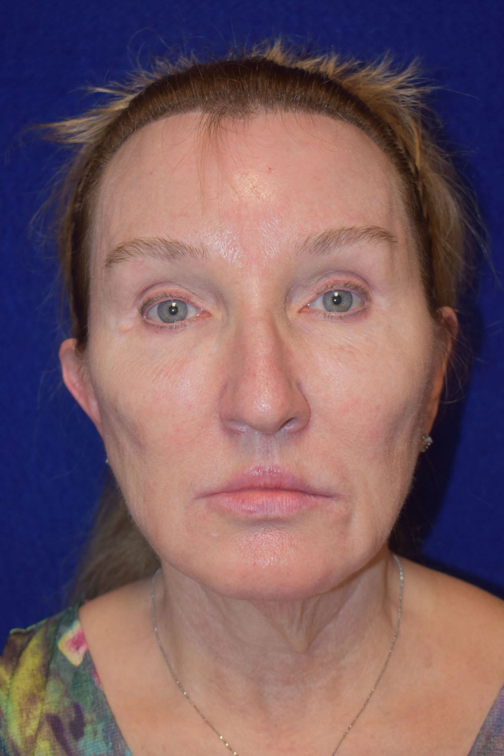 Facial Rejuvenation Before & After