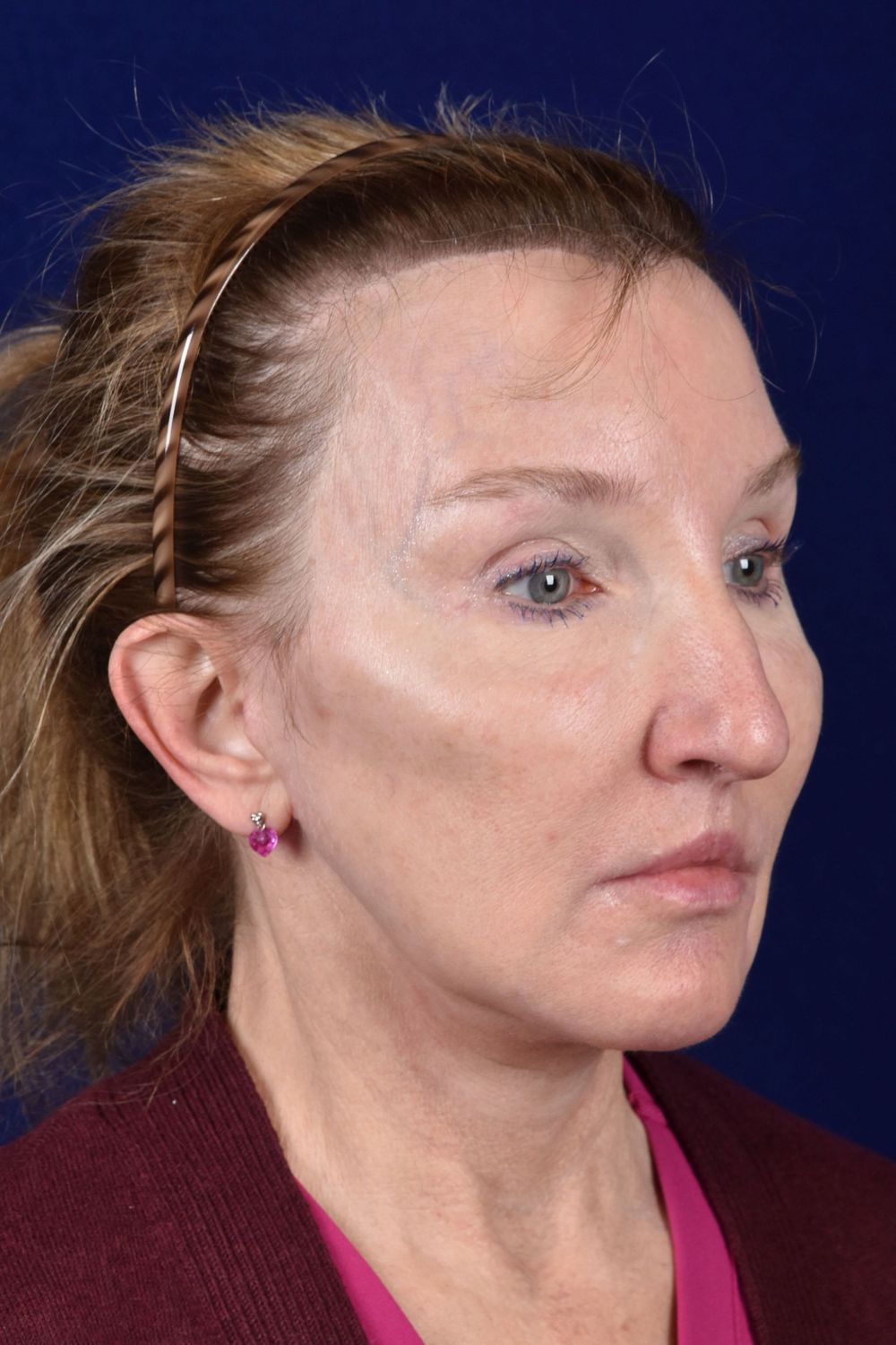 Facial Rejuvenation Before & After
