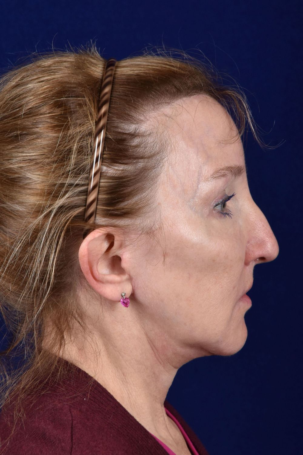 Facial Rejuvenation Before & After