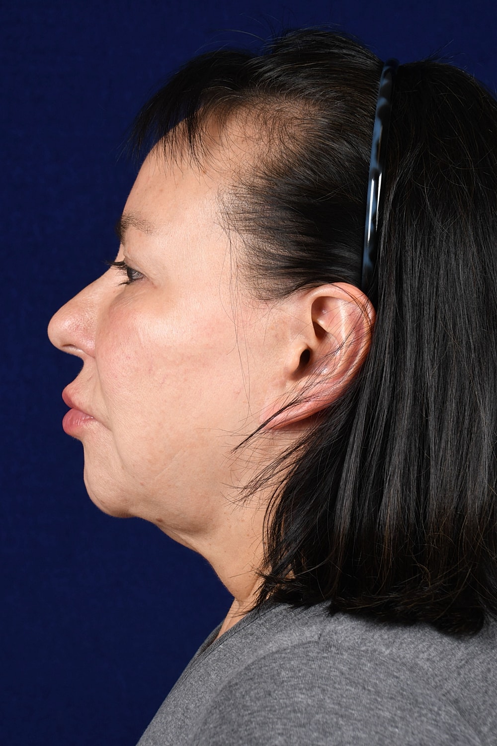 Facial Rejuvenation Before & After