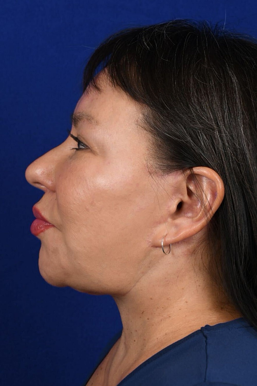 Facial Rejuvenation Before & After