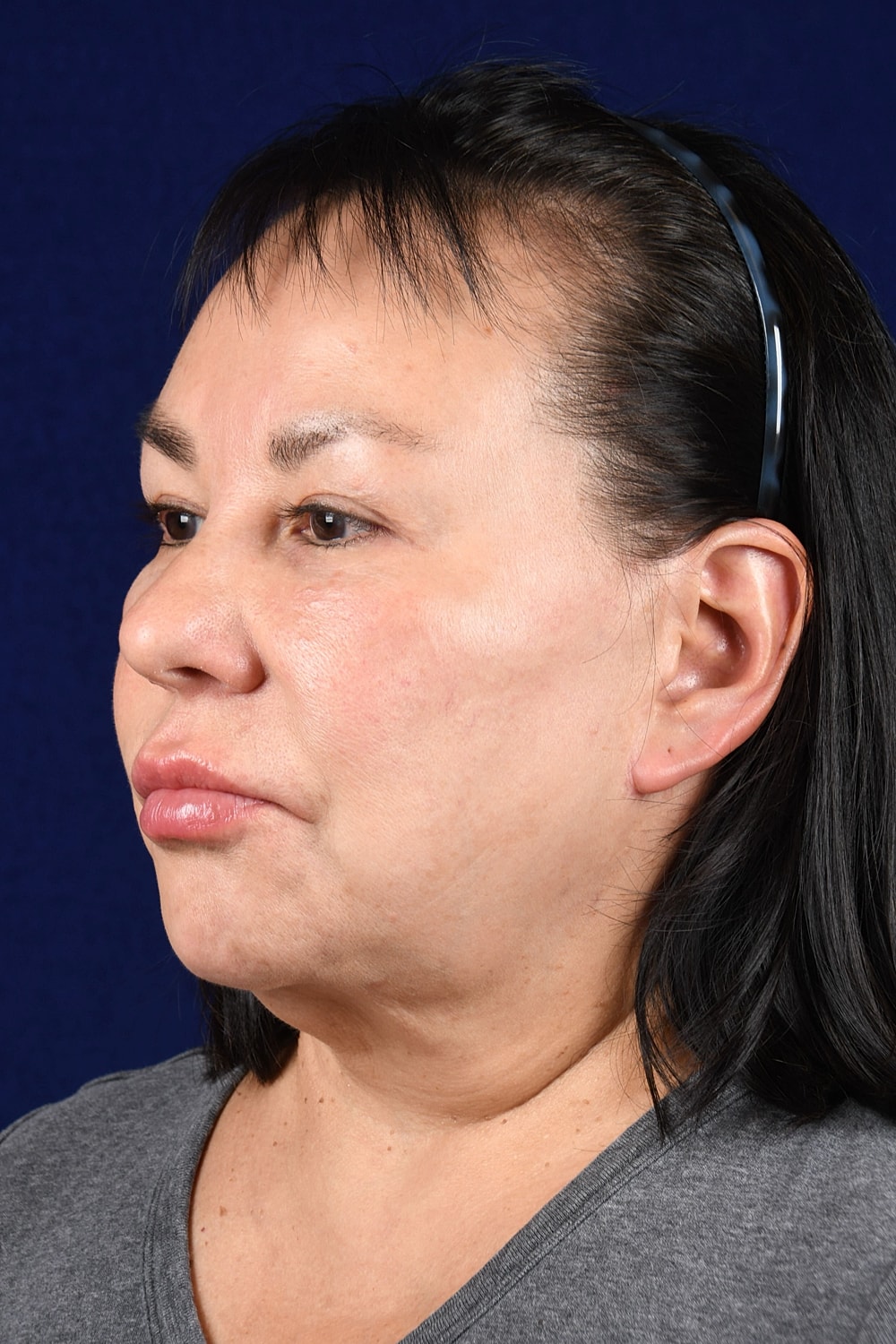 Facial Rejuvenation Before & After