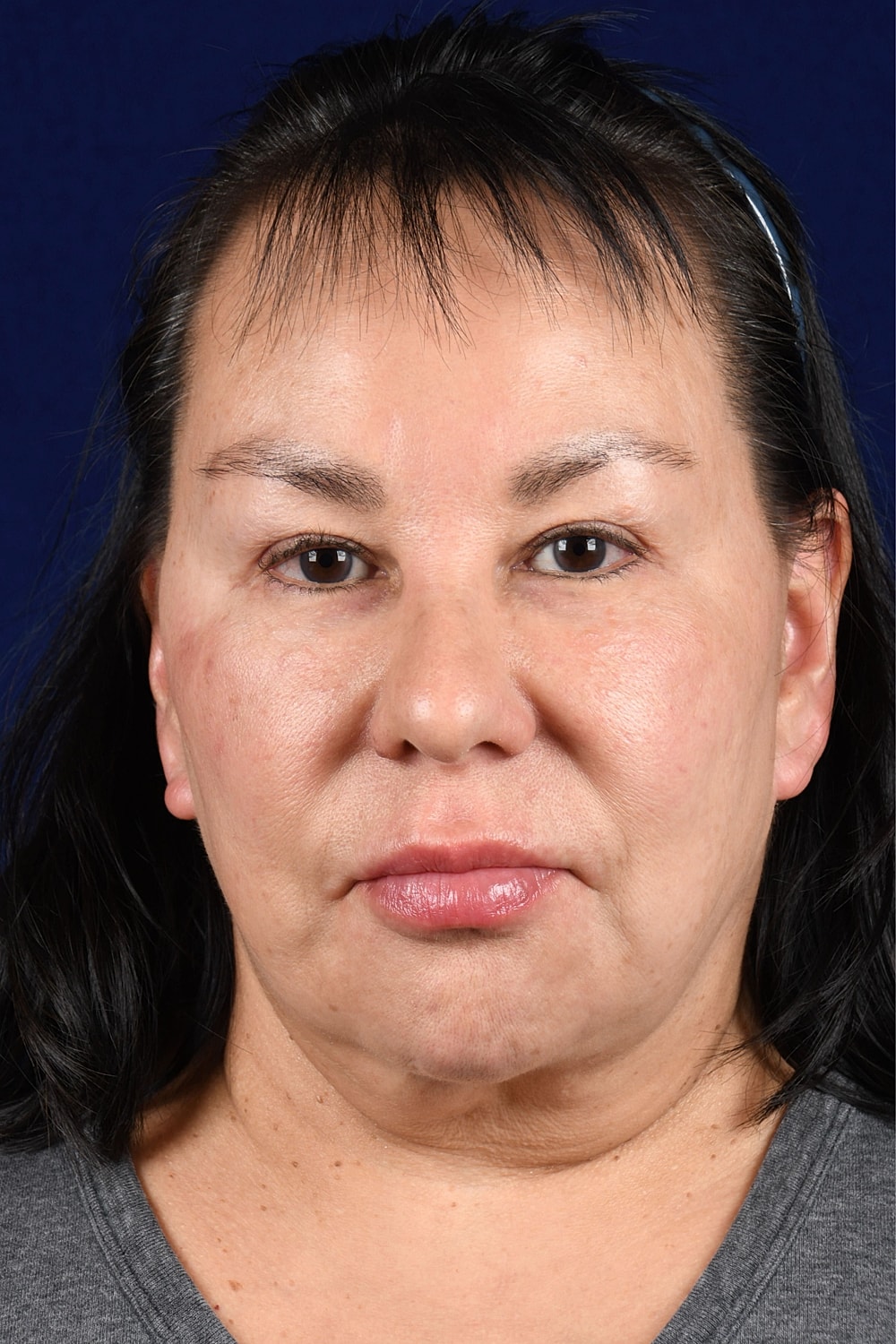 Facial Rejuvenation Before & After