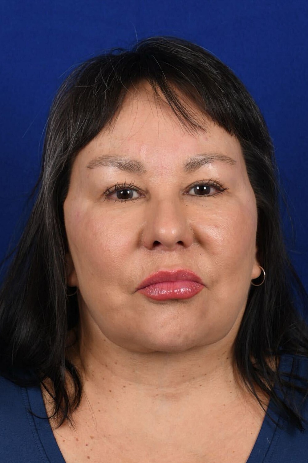 Facial Rejuvenation Before & After