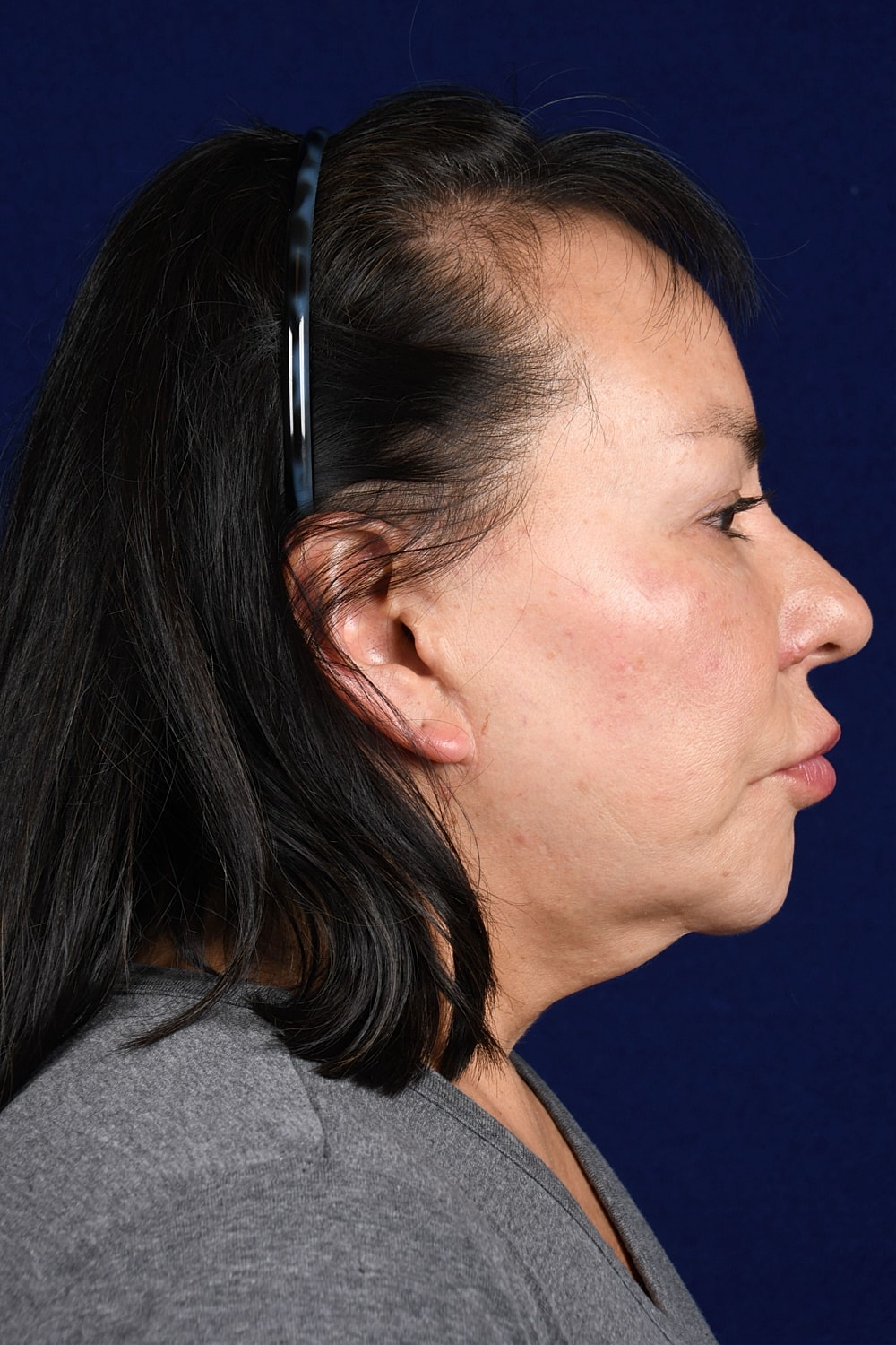 Facial Rejuvenation Before & After