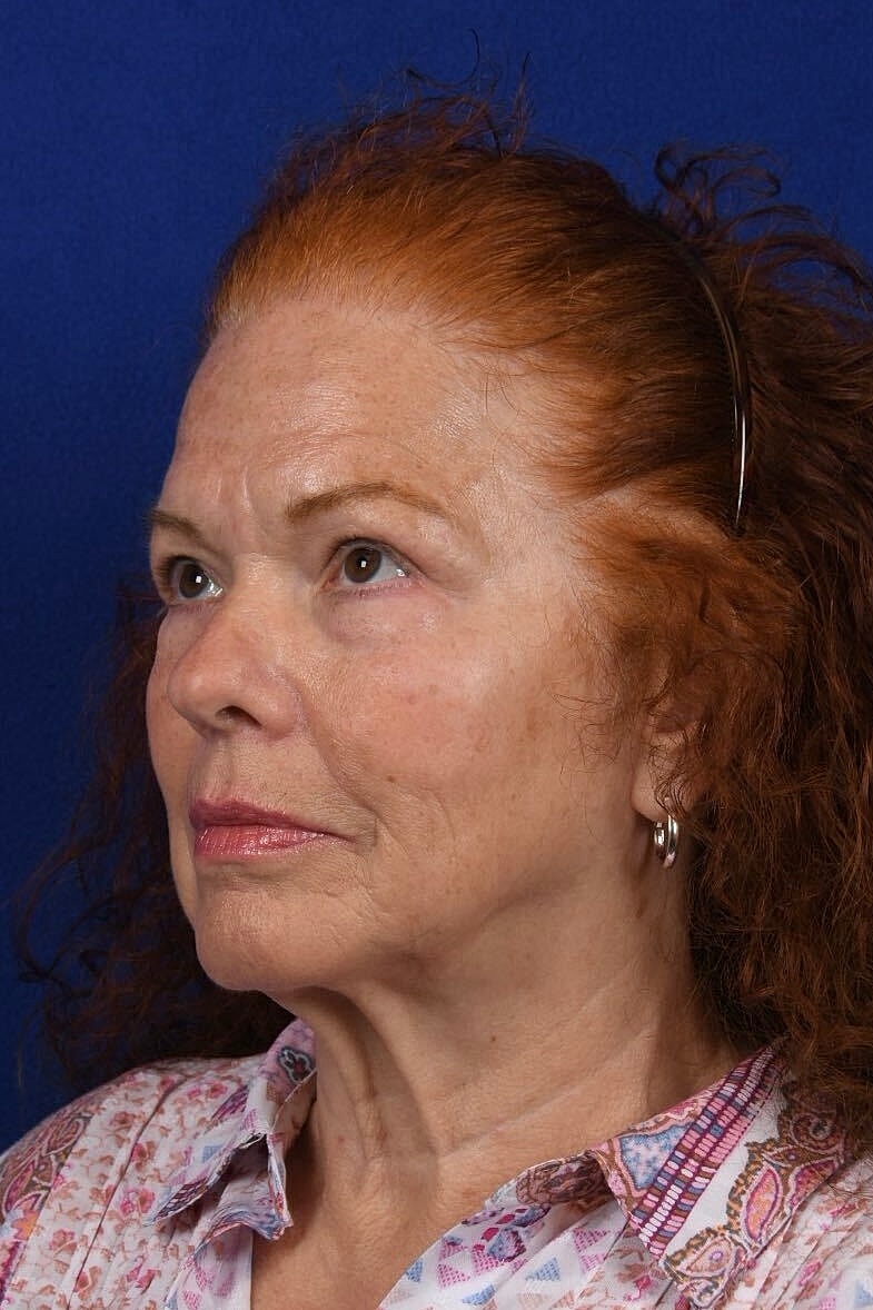 Facial Rejuvenation Before & After