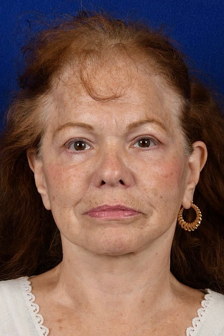 Facial Rejuvenation Before & After