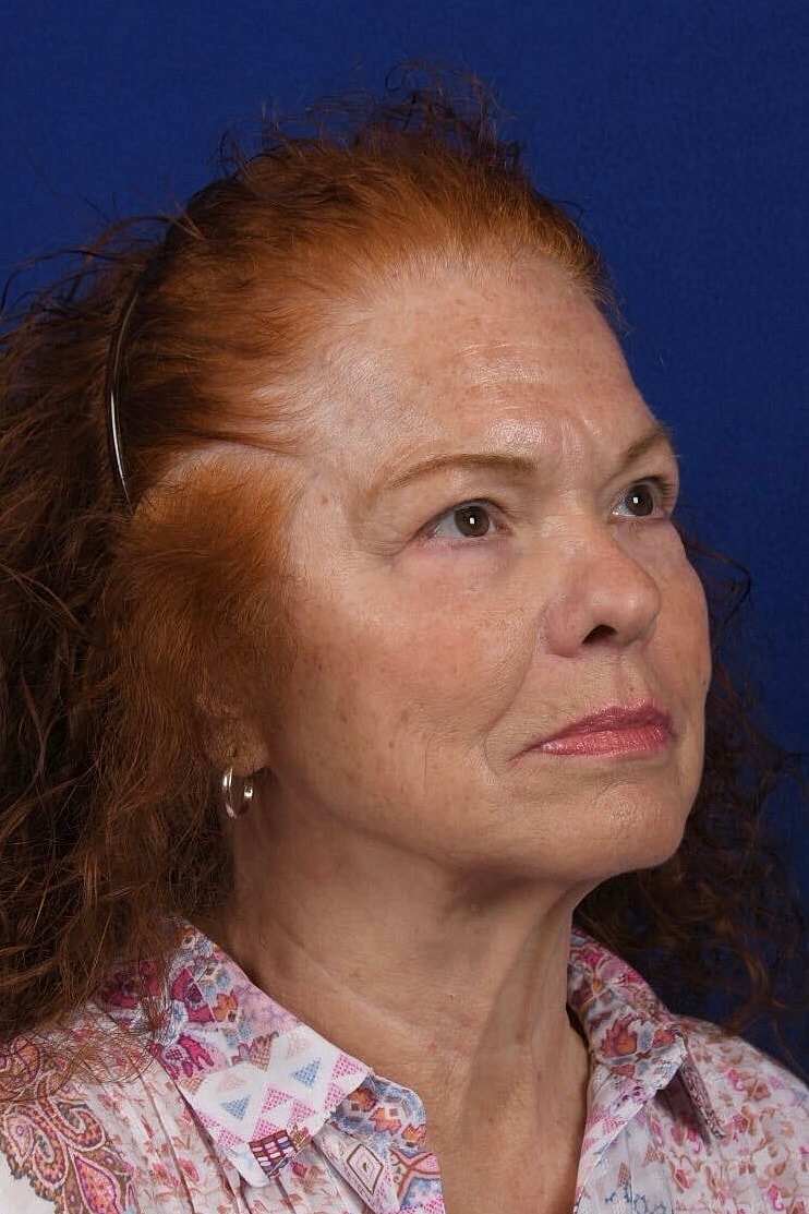Facial Rejuvenation Before & After