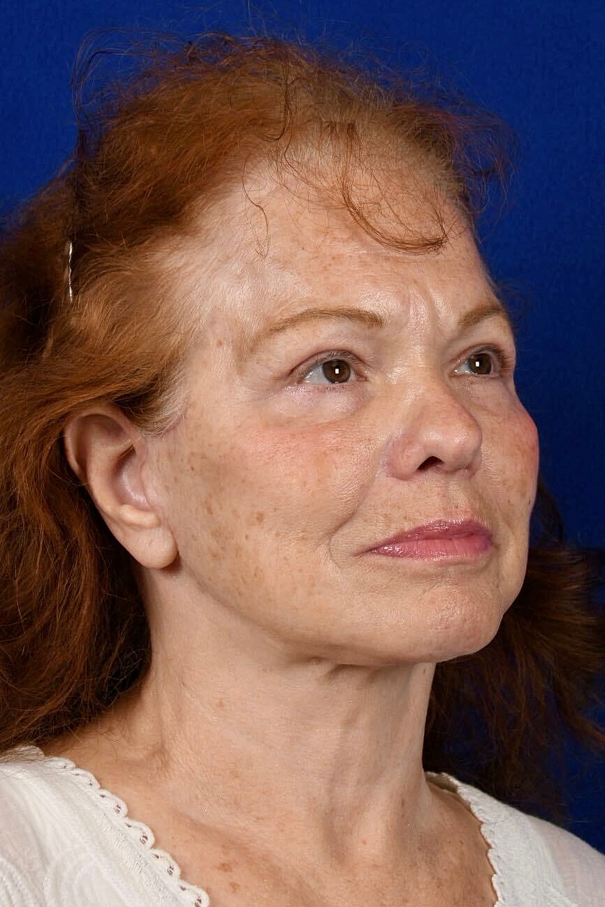 Facial Rejuvenation Before & After