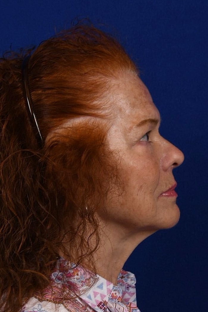 Facial Rejuvenation Before & After