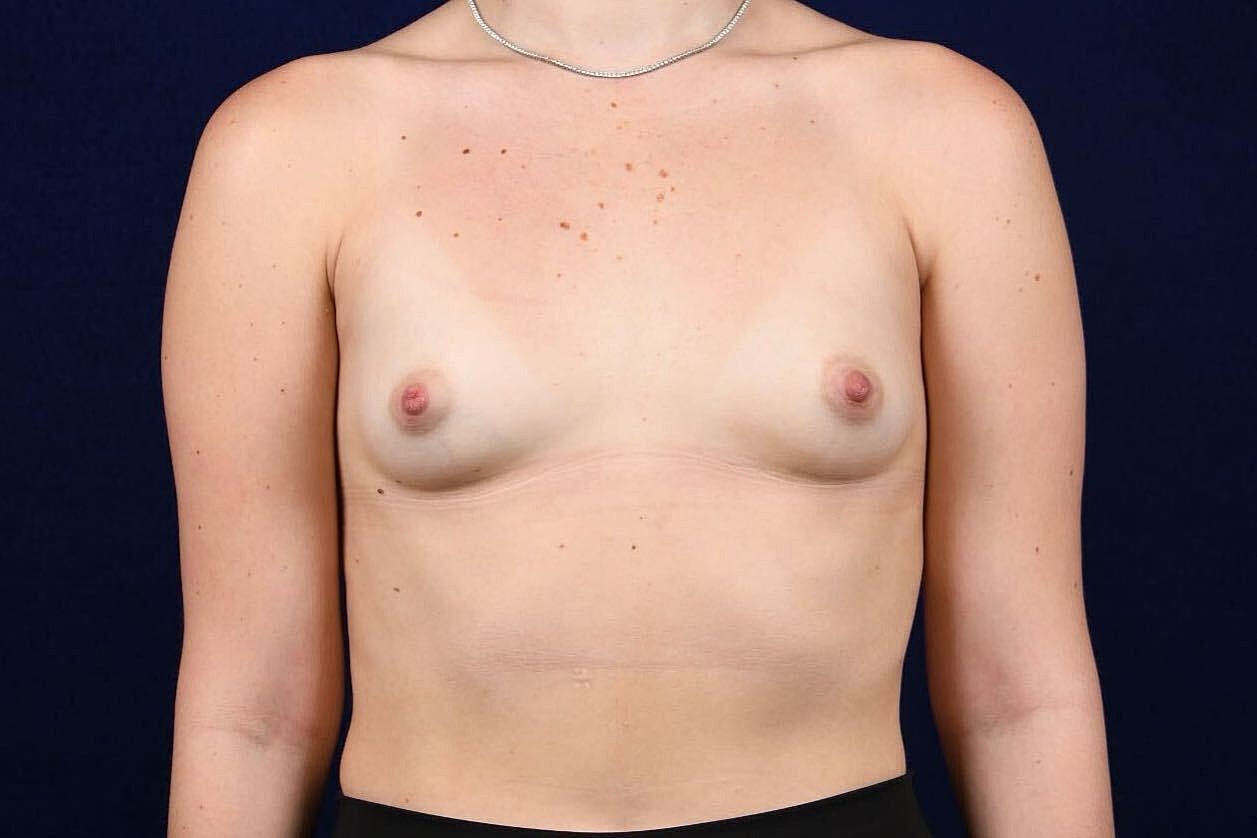 Breast Augmentation Before & After