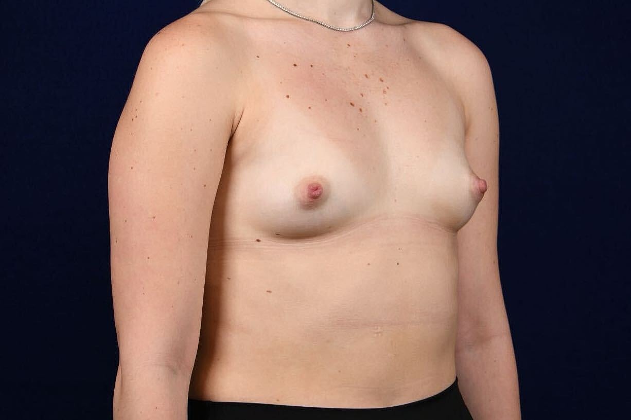 Breast Augmentation Before & After