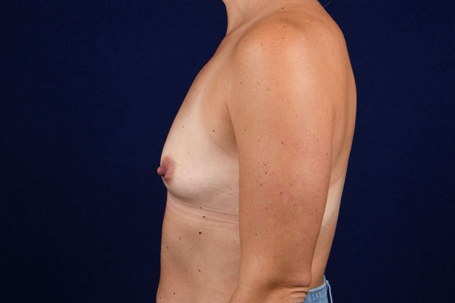 Breast Augmentation Before & After
