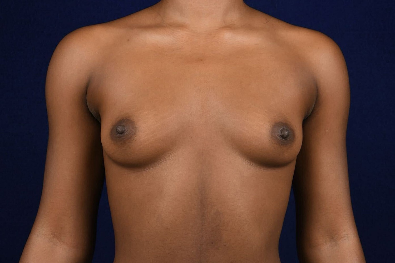 Breast Augmentation Before & After