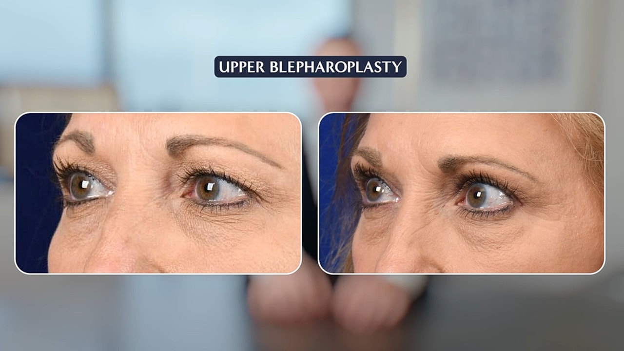 Upper Eyelid Surgery: Refresh Your Eyes and Look More Youthful