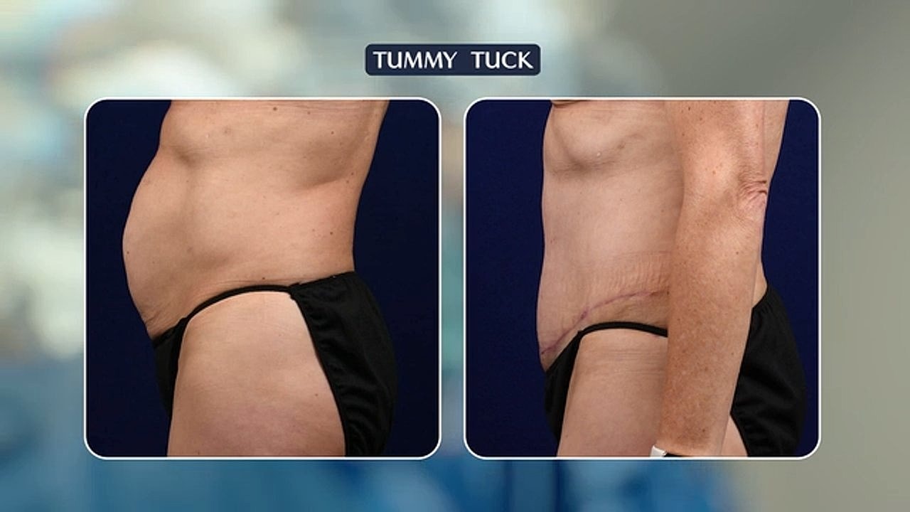 Tummy Tuck vs Liposuction: The Ultimate Guide